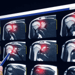 Image shows a surgeon looking at MRI scan of an injured shoulder before rotator cuff surgery