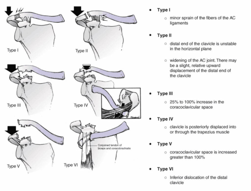 AC Joint injuries are classified in to 6 types. Diagram shows characteristics of injury types