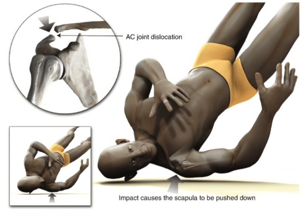 AC Joint traumatic injury can be caused by impact during contact-sports. Acute acromion-clavicular injuries are more common in young adults aged 20-30 years old. 