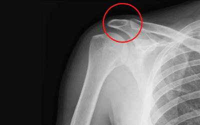 AC joint injury - this image shows the AC joint where the acromion and clavicle meet.