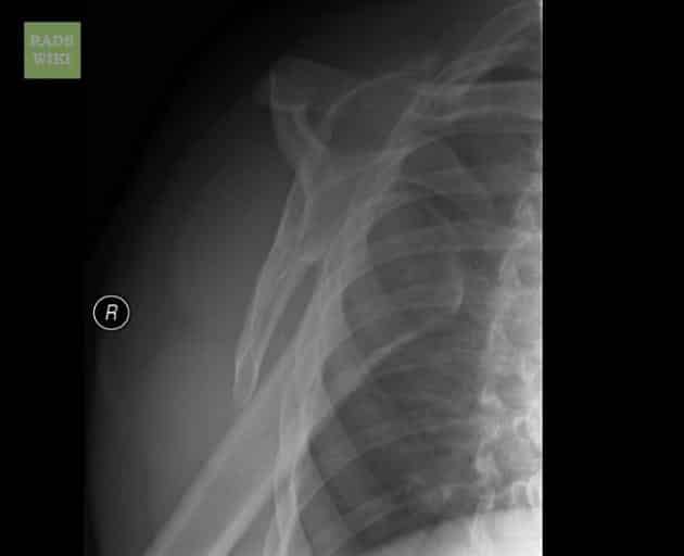 X-ray of Anterior Dislocation of the shoulder. Lateral View
