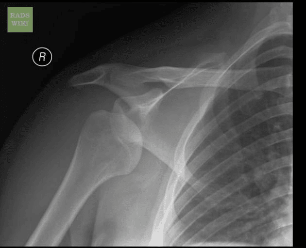 Anterior Shoulder Dislocation X-ray