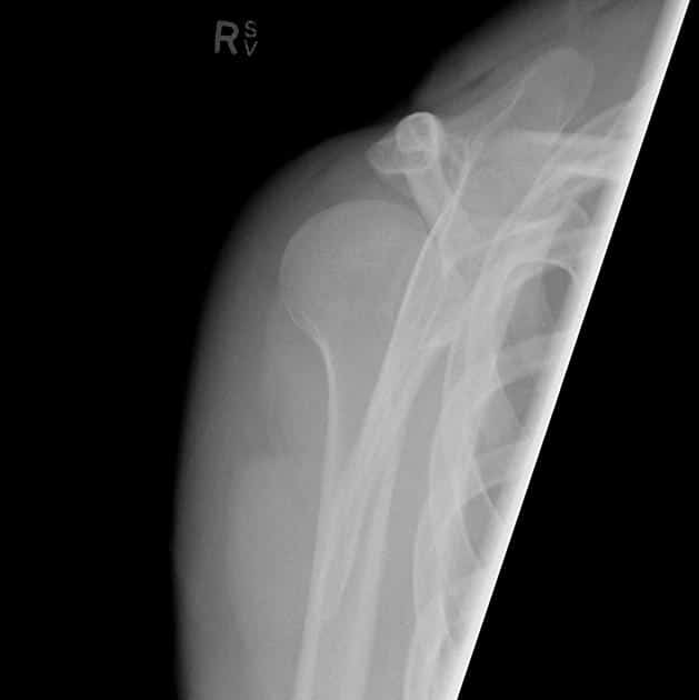 X-ray of posterior dislocation of the shoulder. Lateral view