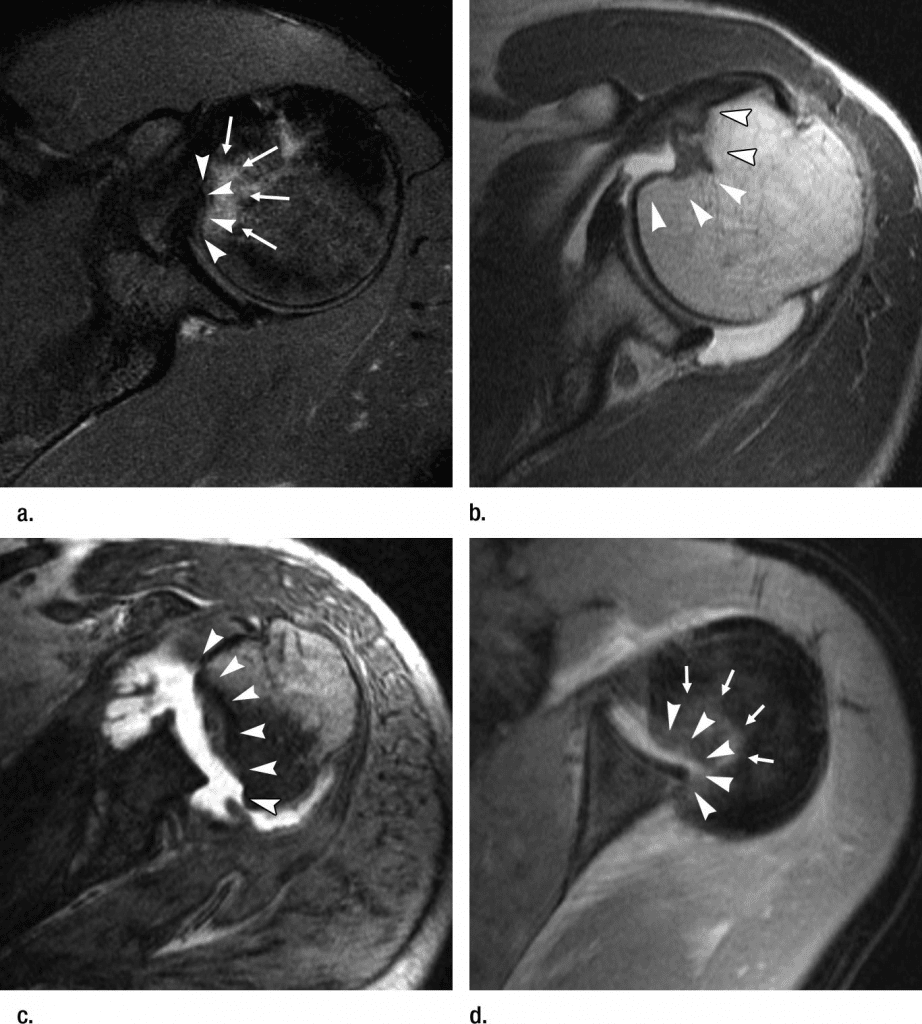 mri shoulder dislocation