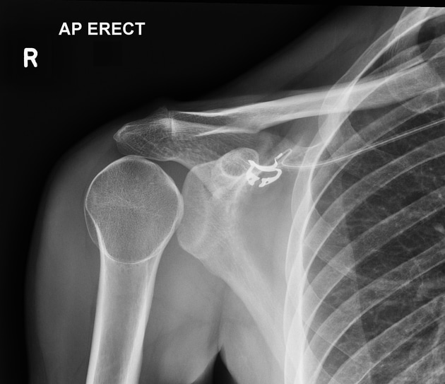 Posterior Dislocation of the shoulder X-ray. Humerus is internally rotated and vacant glenoid can be seen