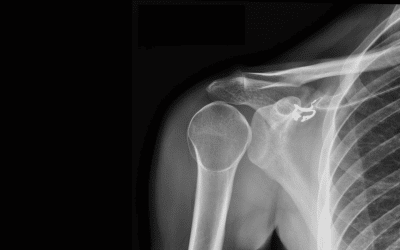 Posterior Shoulder dislocation X-Ray