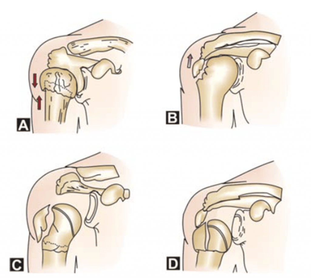 Diagram of shoulder fractures showing 4 types of humerus fracture