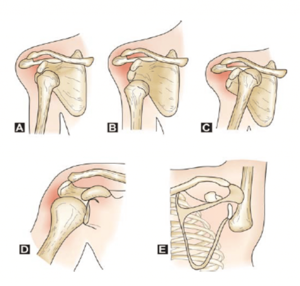 Types of shoulder dislocation; anterior dislocation, posterior dislocation, and inferior dislocation