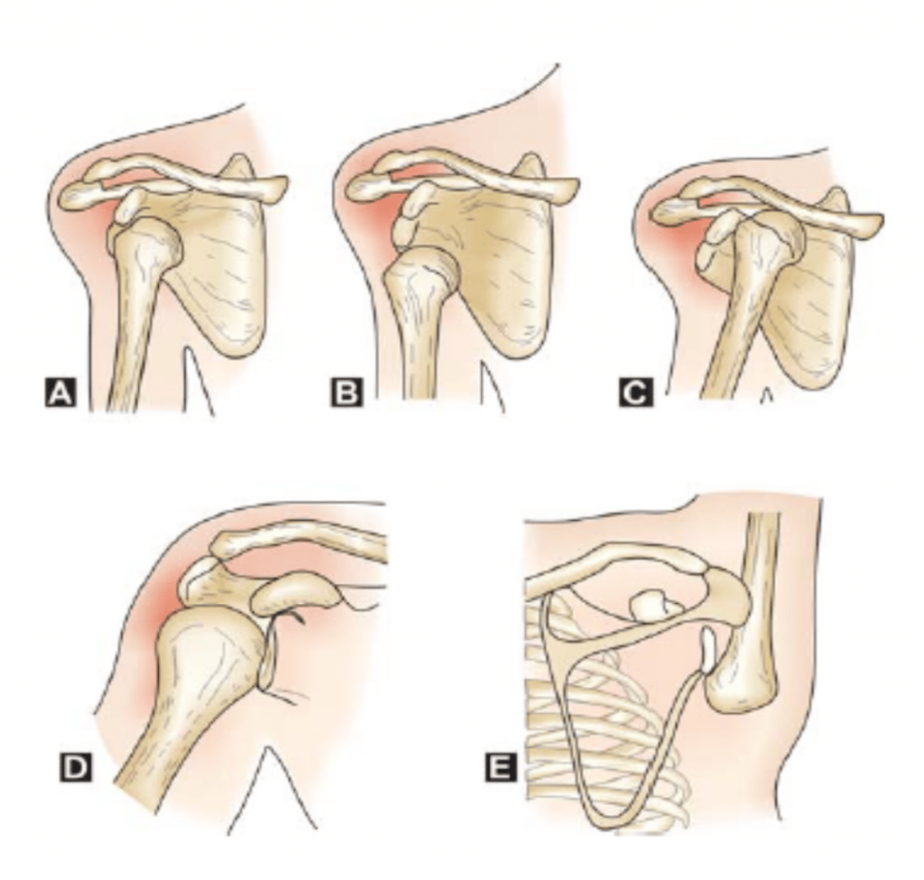 The 3 Types of Shoulder Fractures