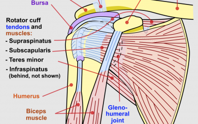 Subscapularis Tendon Tear, diagram shows subscapularis in the shoulder joint