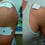 Image shows TENS machine pad placement for shoulder pain. Place one pad above the source of pain and the other below it.