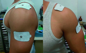 Image shows TENS machine pad placement for shoulder pain. Place one pad above the source of pain and the other below it. 