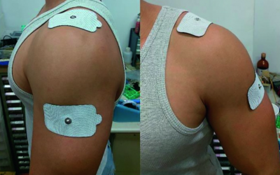 Image shows TENS machine pad placement for shoulder pain. Place one pad above the source of pain and the other below it.